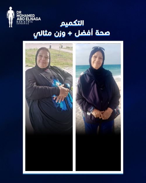 لماذا تكميم المعدة؟